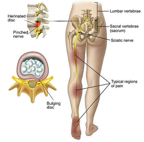 Courthouse Chiropractic - Sciatic Nerve Pain